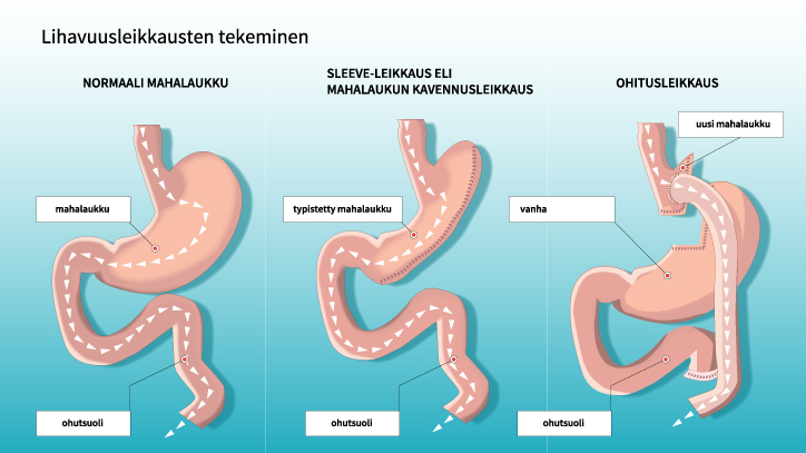 Lihavuusleikkausten eri tyypit